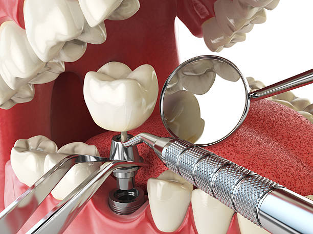 Best Emergency Wisdom Teeth Removal in Rockingham, NC